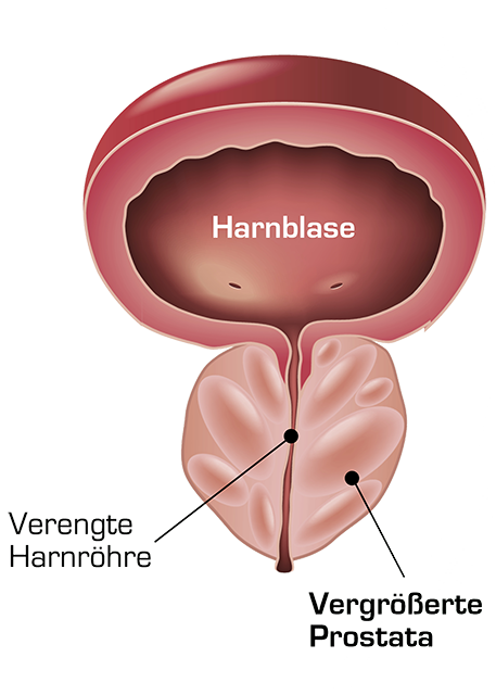 prostata vergrößerung prostatite batterica sintomi e cura